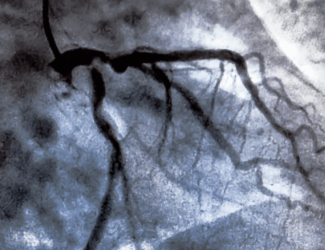 Cateterismo cardiaco y angioplastia